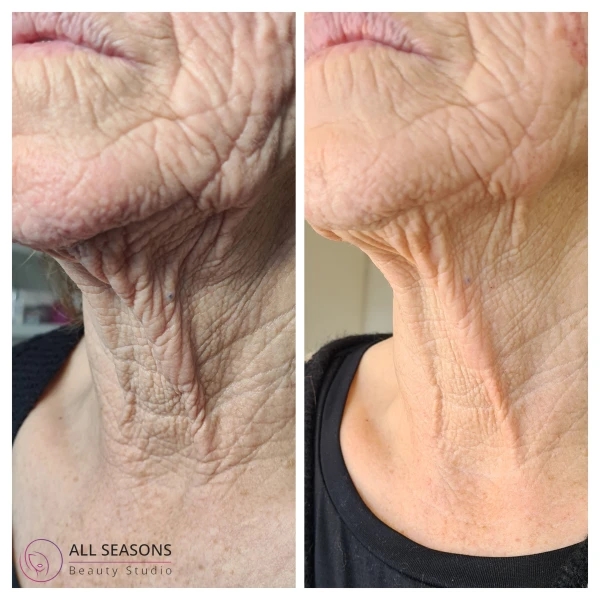 Neck Lift Cream